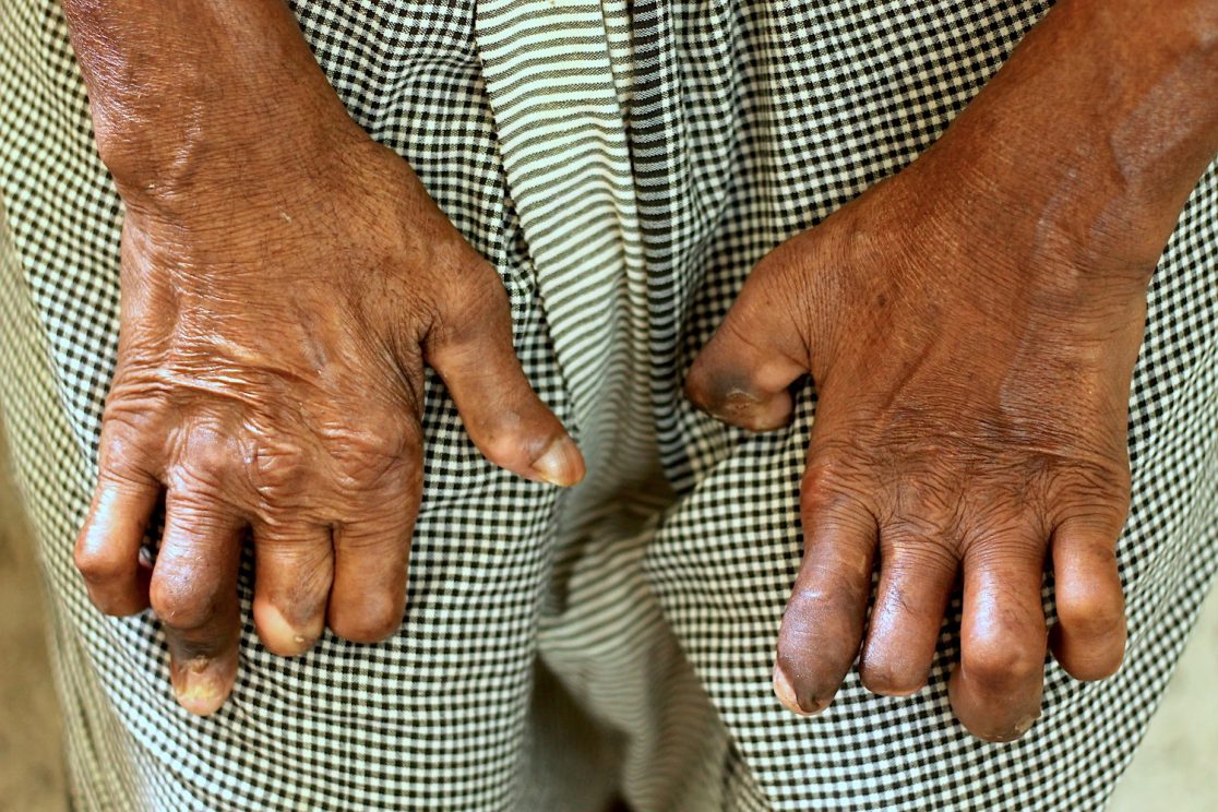 Zinggl_Reportage_WienerZeitung_Nepal_Lepra_Lalgadh_Leprosy_Clinic_01