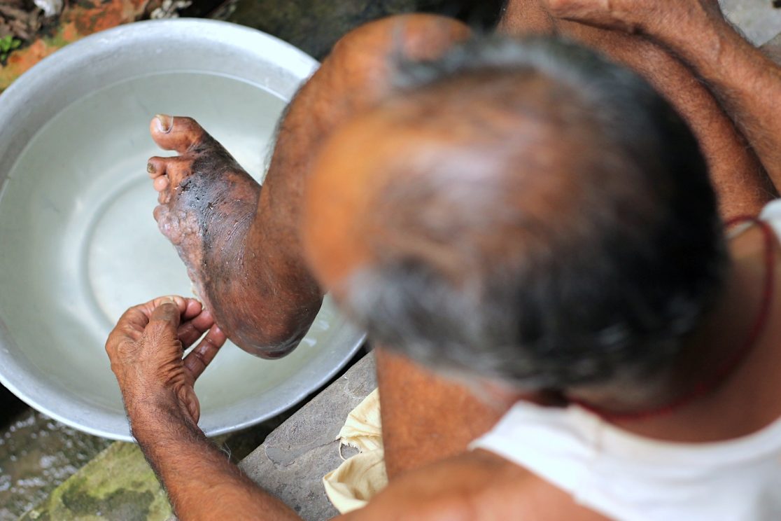 Zinggl_Reportage_WienerZeitung_Nepal_Lepra_Lalgadh_Leprosy_Clinic_07